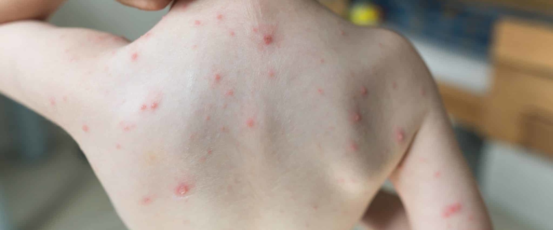 Recognizing the Signs of Bacterial Infections in Children