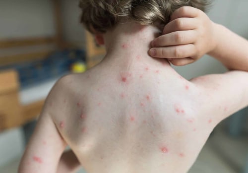 Recognizing the Signs of Bacterial Infections in Children